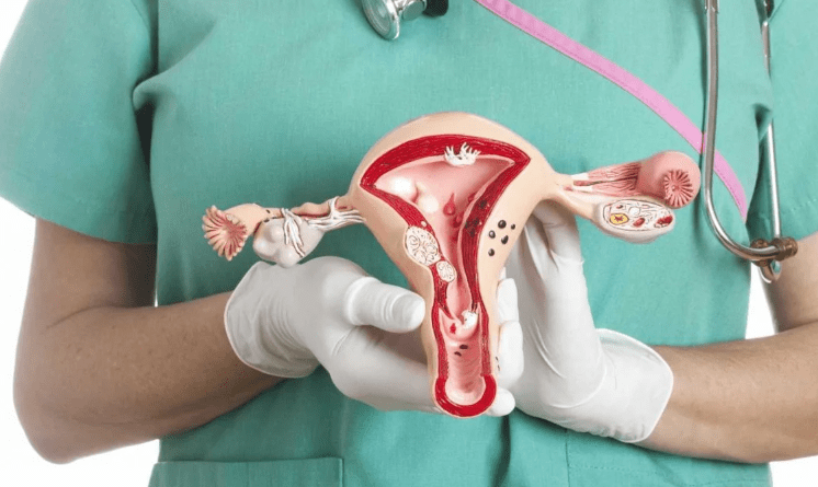 Advierten por el diagnóstico tardío del cáncer de ovario y su impacto en los&nbsp;tratamientos